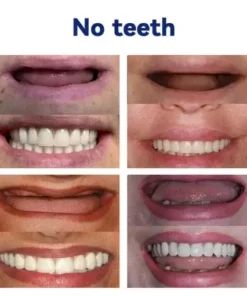 Advanced Customized Full Denture Set