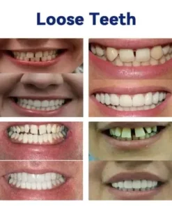 Advanced Customized Full Denture Set