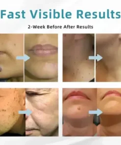 All-in-One CO₂ Laser Eraser Pen