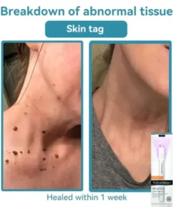 All-in-One Laser Eraser Pen