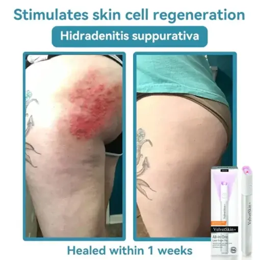 All-in-One Laser Eraser Pen