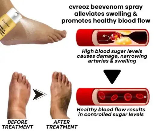 Bee Venom Diabetic Foot Treatment Spray