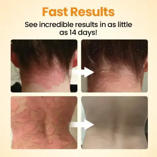 BeeLieve Psoriasis Skin Care