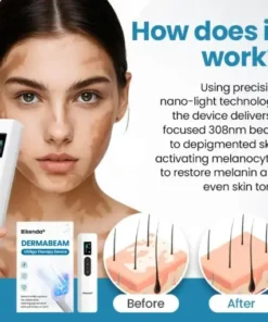 DermaBeam Vitiligo Therapy device