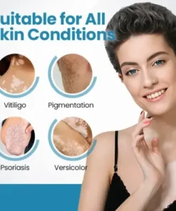 DermaBeam Vitiligo Therapy device