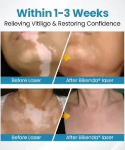 DermaBeam Vitiligo Therapy device