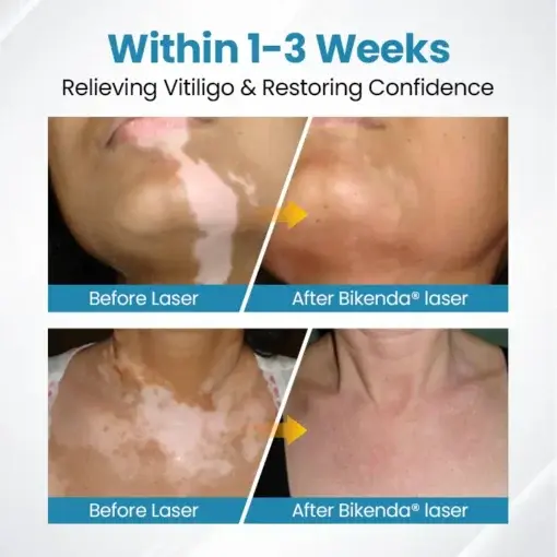 DermaBeam Vitiligo Therapy device