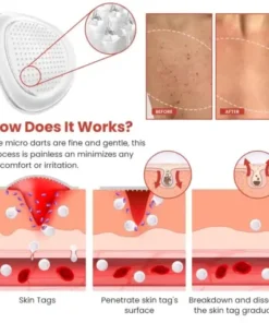 DermaSmooth Skin Tag Remover Patch