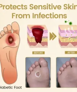 Diabetic Foot Healing Spray – Bee Venom Infused