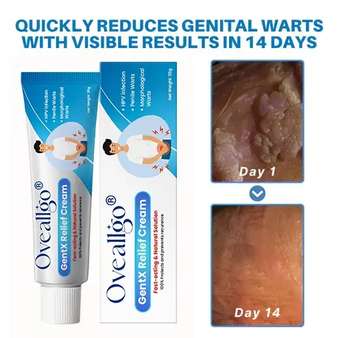 Genital Warts Relief Cream