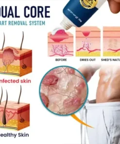 Genital Warts Remover Cream