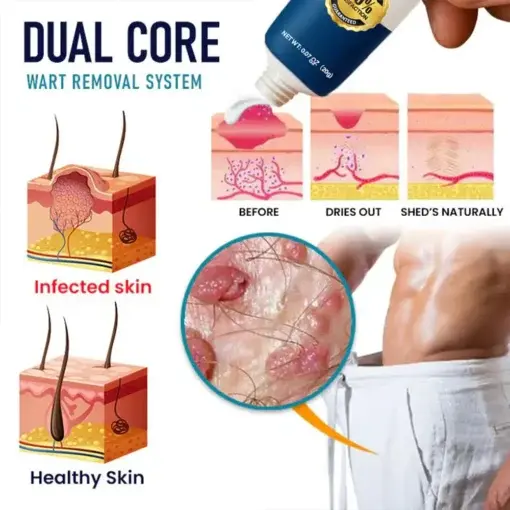 Genital Warts Remover Cream