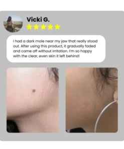 Home Use CO2 Laser Shot Erase Pro