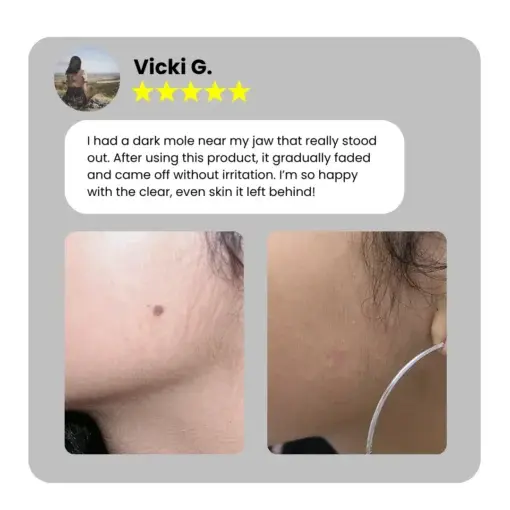 Home Use CO2 Laser Shot Erase Pro