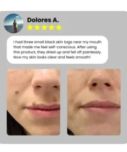 Home Use CO2 Laser Shot Erase Pro