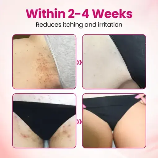 IntiDefend Anti-HPV Interferon Gel