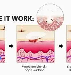 Magnesium MicroPin Target & Clear Wart Removal Patch