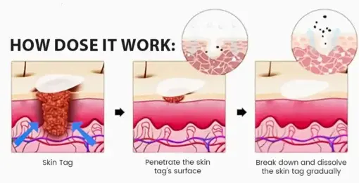 Magnesium MicroPin Target & Clear Wart Removal Patch