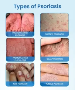 MagnesiumHerb Psoriasis Relief Cream