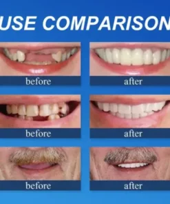 NESLEMY™ –Advanced Customized Full Denture Set