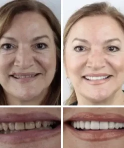 NESLEMY™ –Advanced Customized Full Denture Set