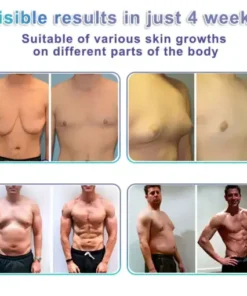 NanoMedix Gynecomastia Chest Fatburn & Firm Patch