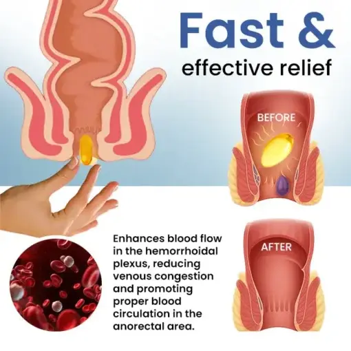 Natural Hemorrhoid Capsules