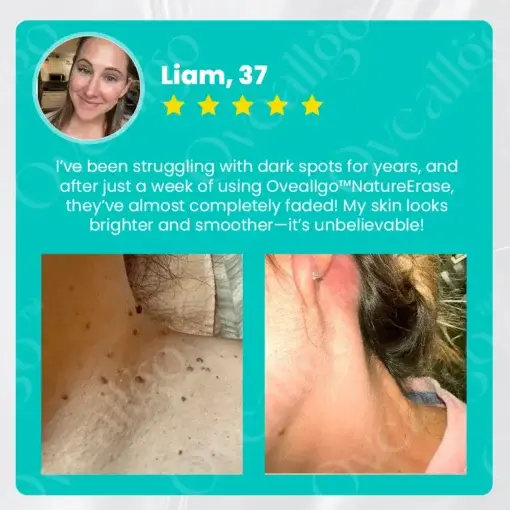 NatureErase Instant Mole & Spot Cream