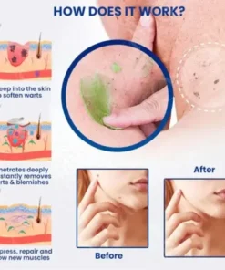 NatureErase Superior Instant Mole & Spot Removal Gel