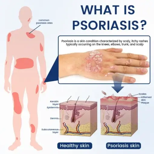 PsoriCure Magnesium Herbal Spray