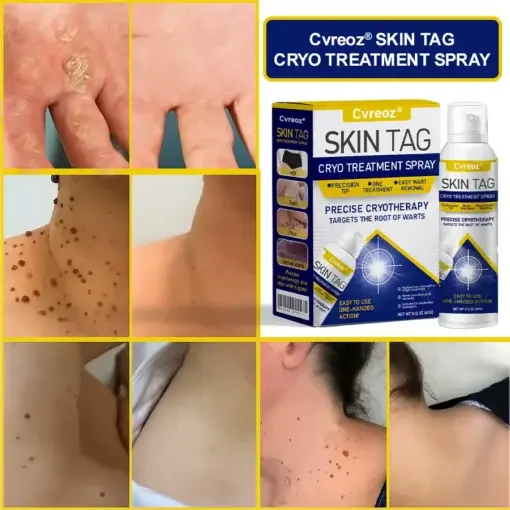 Skin Tag Cryo Treatment Spray