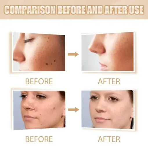 Skin Tag & Mole Remover