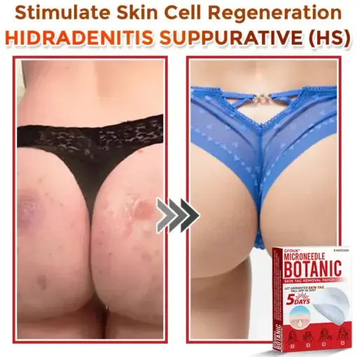 Skin Tag Removal Patch