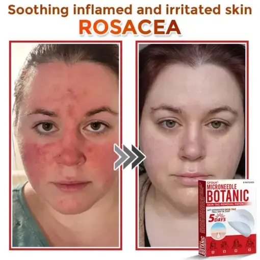 Skin Tag Removal Patch