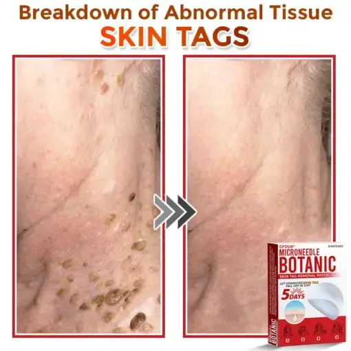 Skin Tag Removal Patch