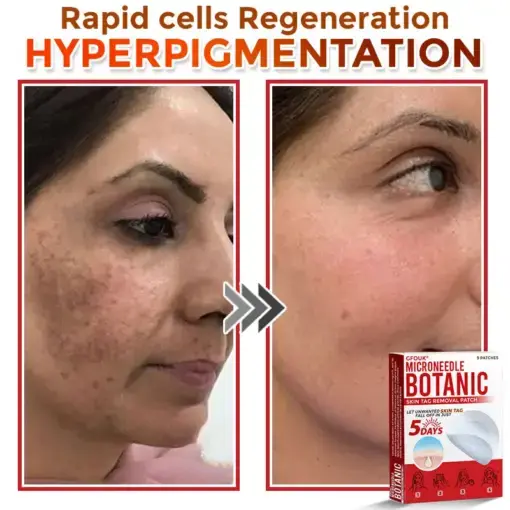 Skin Tag Removal Patch