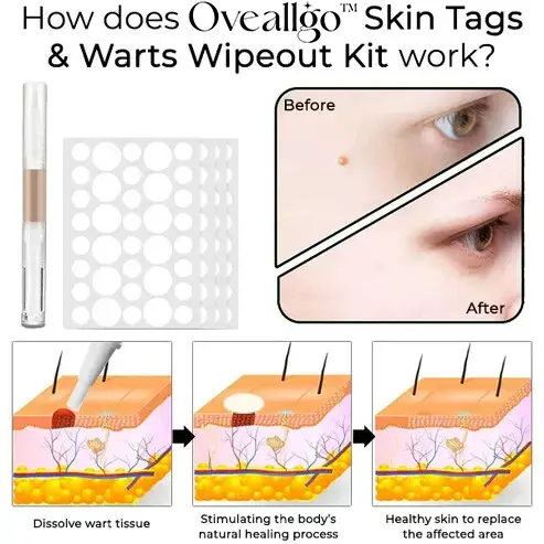Skin Tags & Warts Wipeout Kit