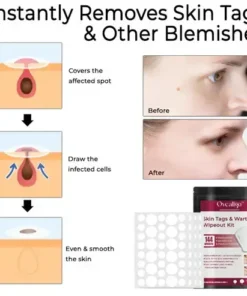 Skin Tags & Warts Wipeout Kit