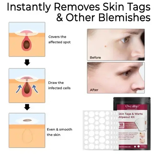 Skin Tags & Warts Wipeout Kit