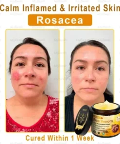 Skin Treatment Cream