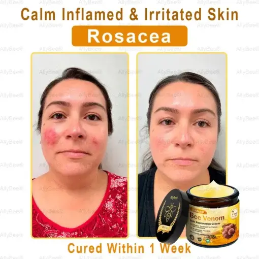 Skin Treatment Cream