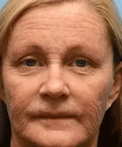 Skin Treatment Cream