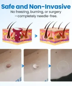 TagGone Wart Removal Cream