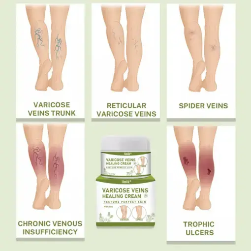 Varicose Veins Healing Cream