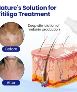 Vitiligo Treatment Spray