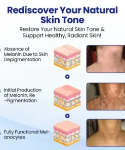 Vitiligo Treatment Spray