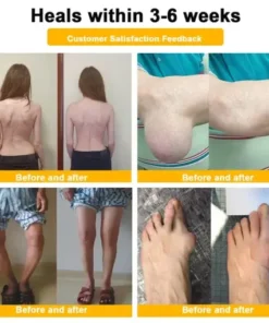 Botulinum Toxin & Bee Venom Pain-Relief Bone Healing Cream