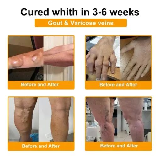 Botulinum Toxin & Bee Venom Pain-Relief Bone Healing Cream